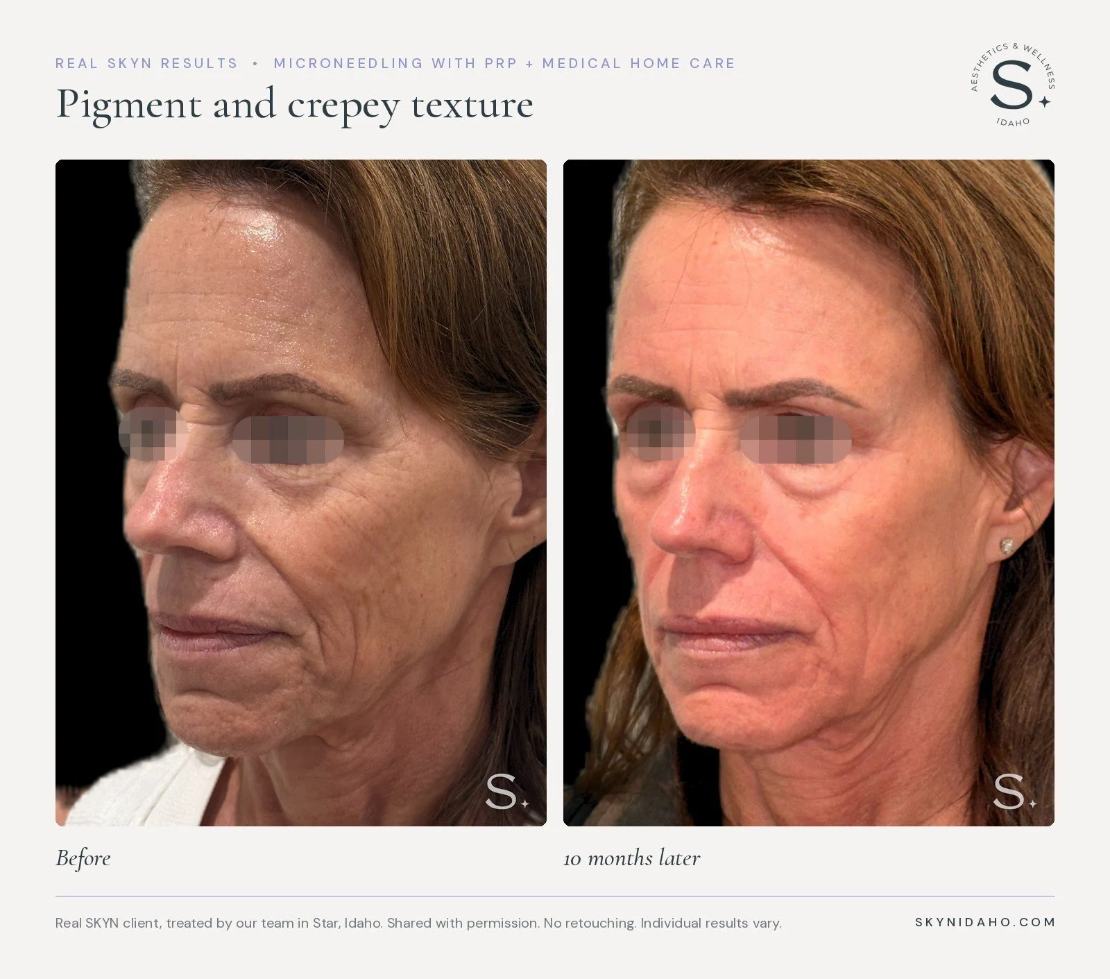 Before and after, Pigment and crepey texture, 10 months later, at SKYN in Star, Idaho