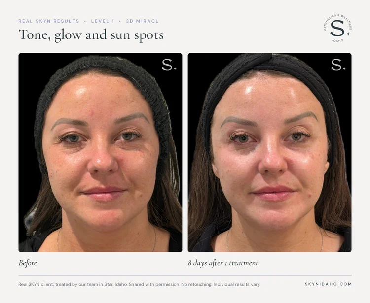 Before and after, Tone, glow and sun spots, 8 days after 1 treatment, Level 1 · 3D MIRACL