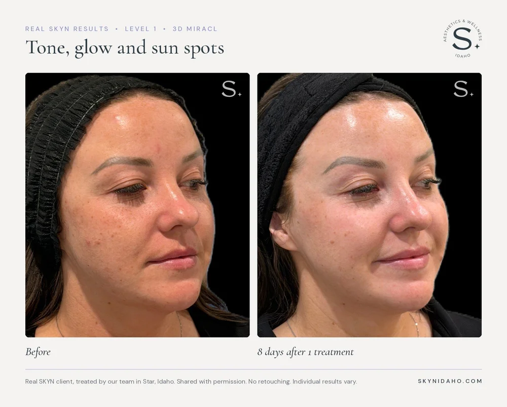 Before and after UltraClear laser for tone, glow and sun spots at SKYN in Star, Idaho