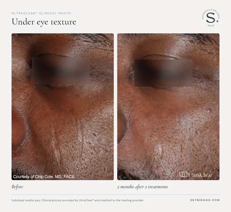 Before and after, Under eye texture, 2 months after 2 treatments