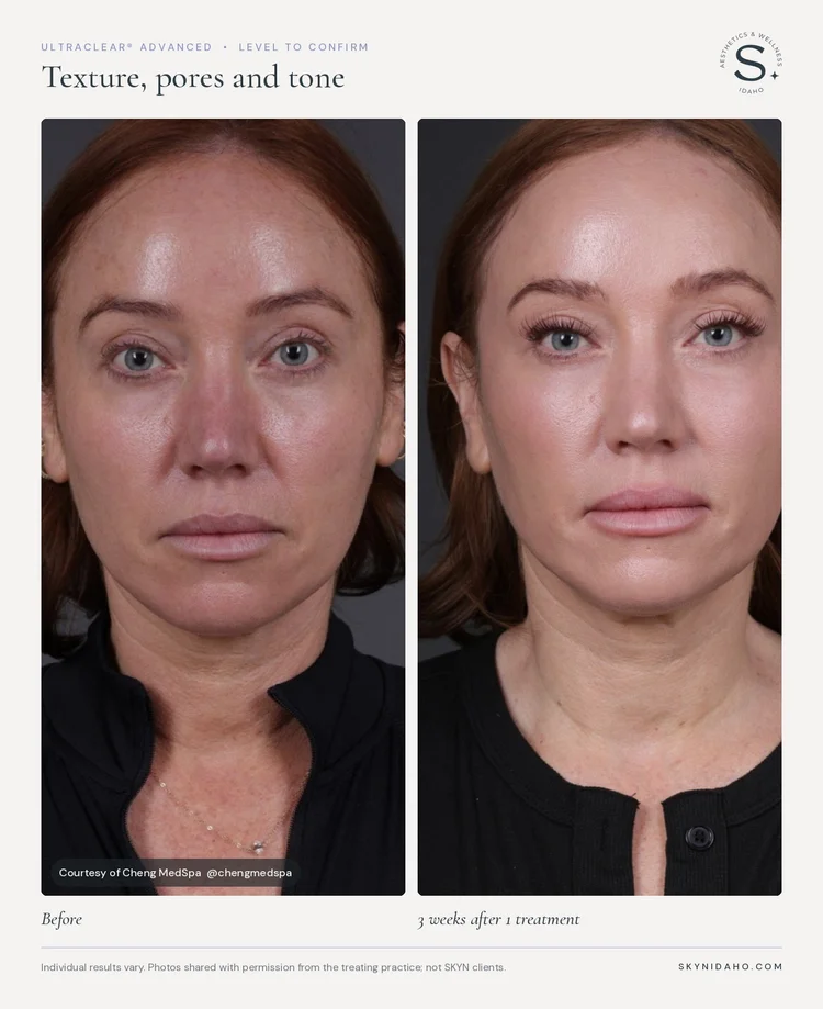Before and after, Texture, pores and tone, 3 weeks after 1 treatment