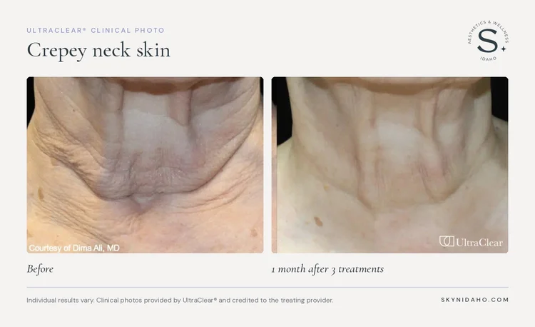 Before and after, Crepey neck skin, 1 month after 3 treatments