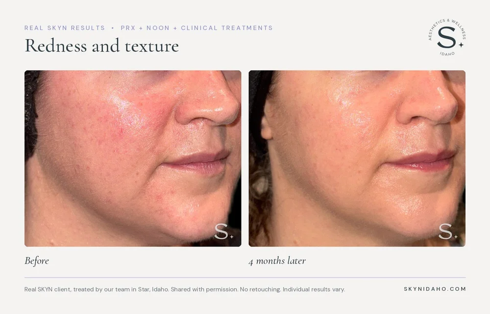 Before and after, Redness and texture, 4 months later