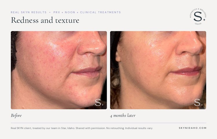 Before and after, Redness and texture, 4 months later