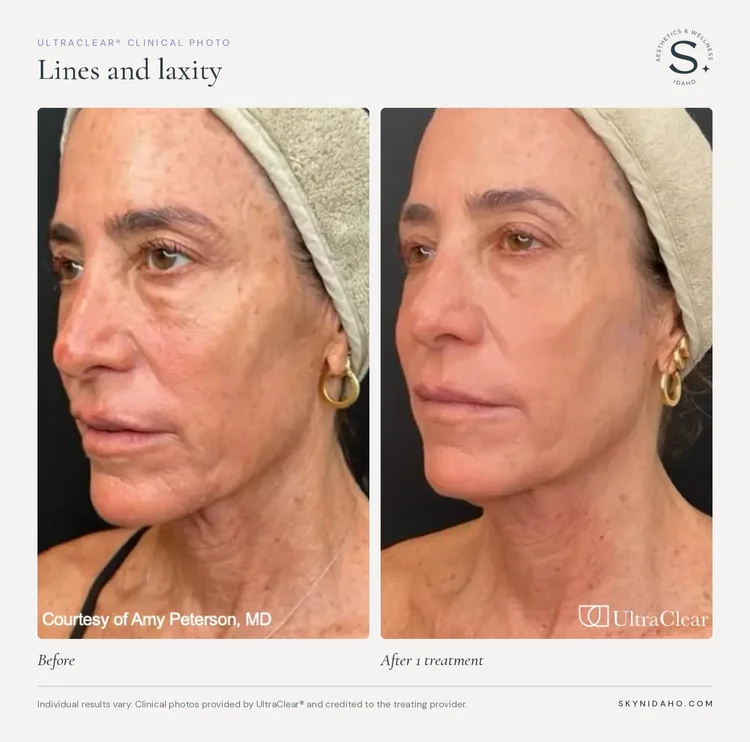 Before and after, Lines and laxity, After 1 treatment