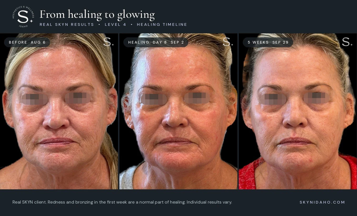 A real SKYN Level 4 UltraClear client healing from treatment day to five weeks
