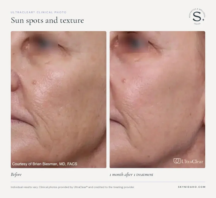 Before and after, Sun spots and texture, 1 month after 1 treatment