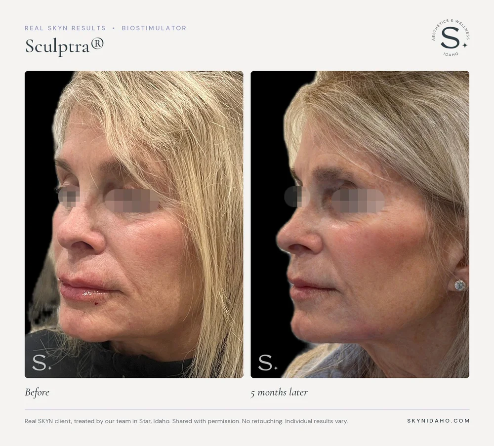 Before and after, Sculptra®, 5 months later