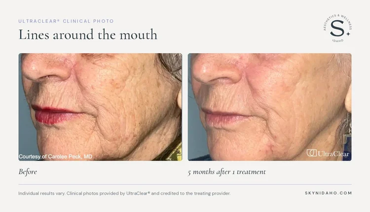 Before and after, Lines around the mouth, 5 months after 1 treatment
