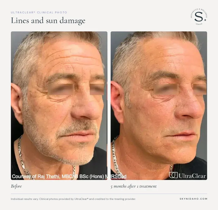 Before and after, Lines and sun damage, 5 months after 1 treatment