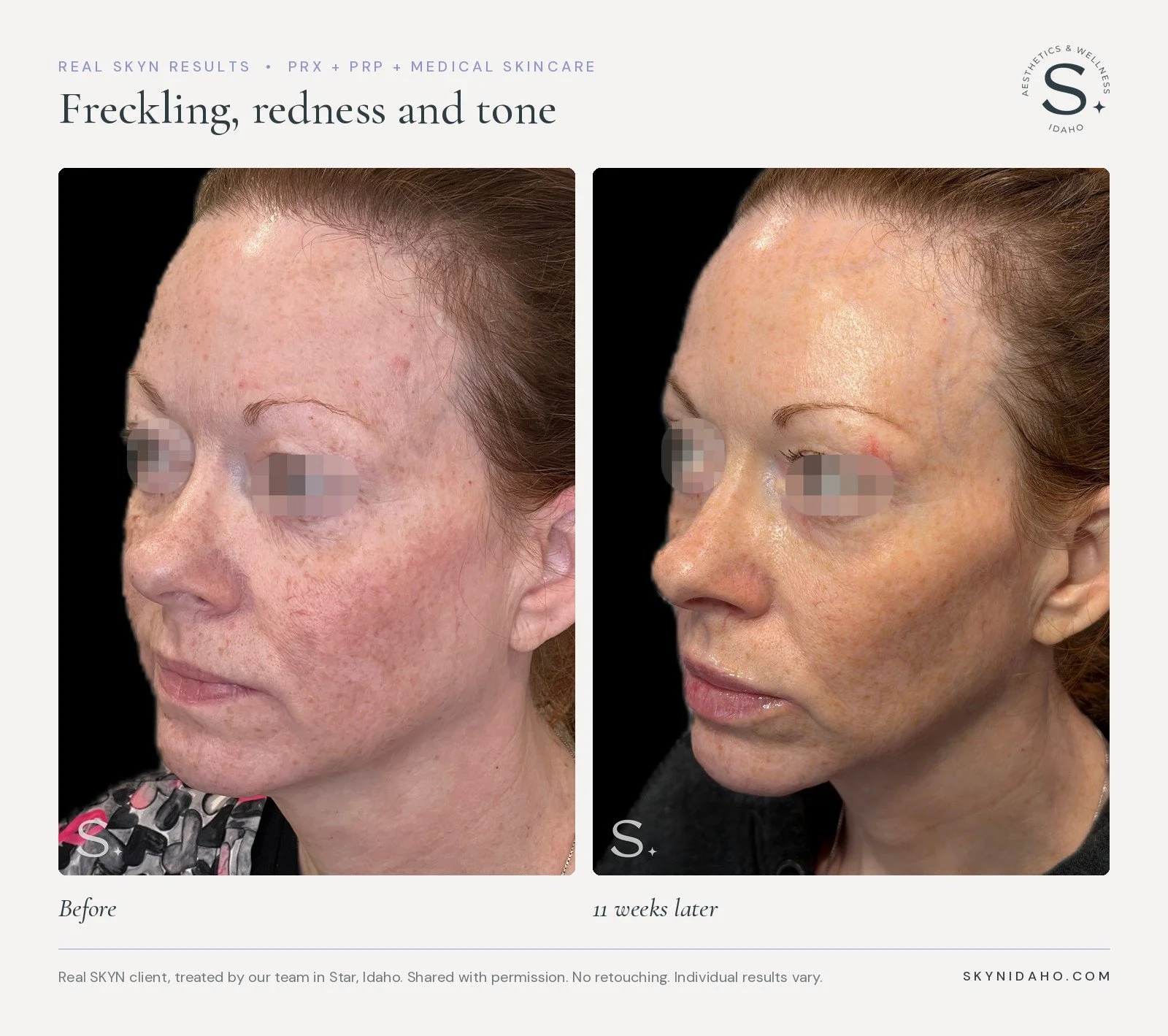 Before and after, Freckling, redness and tone, 11 weeks later, at SKYN in Star, Idaho