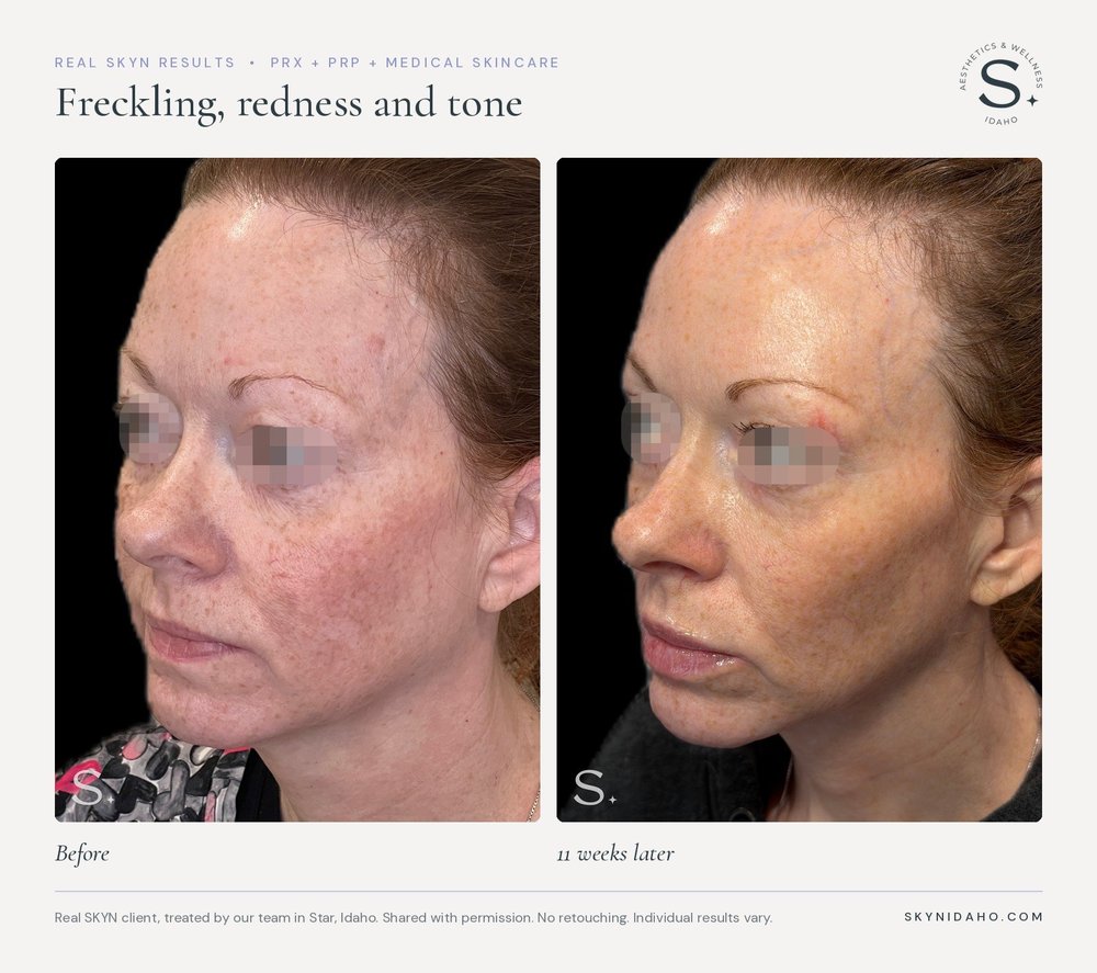 Before and after, Freckling, redness and tone, 11 weeks later