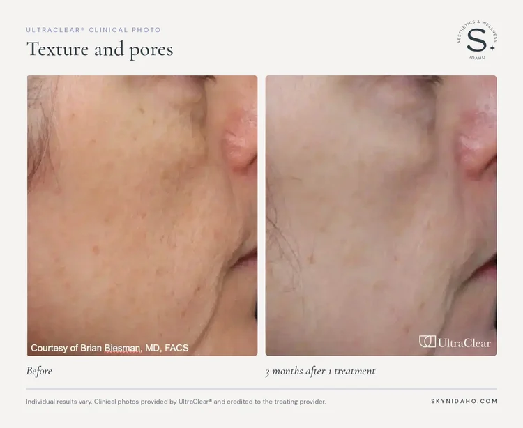 Before and after, Texture and pores, 3 months after 1 treatment