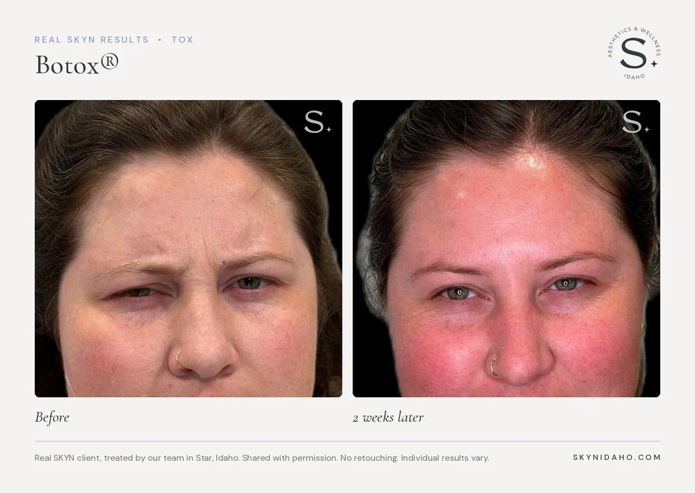 Before and after Botox for frown lines at SKYN in Star, Idaho