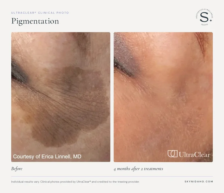 Before and after, Pigmentation, 4 months after 2 treatments