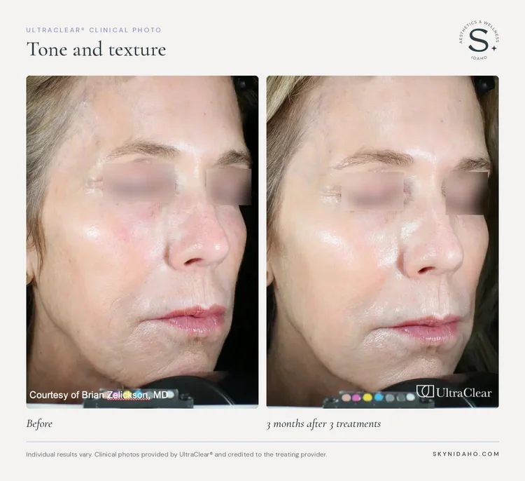 Before and after, Tone and texture, 3 months after 3 treatments