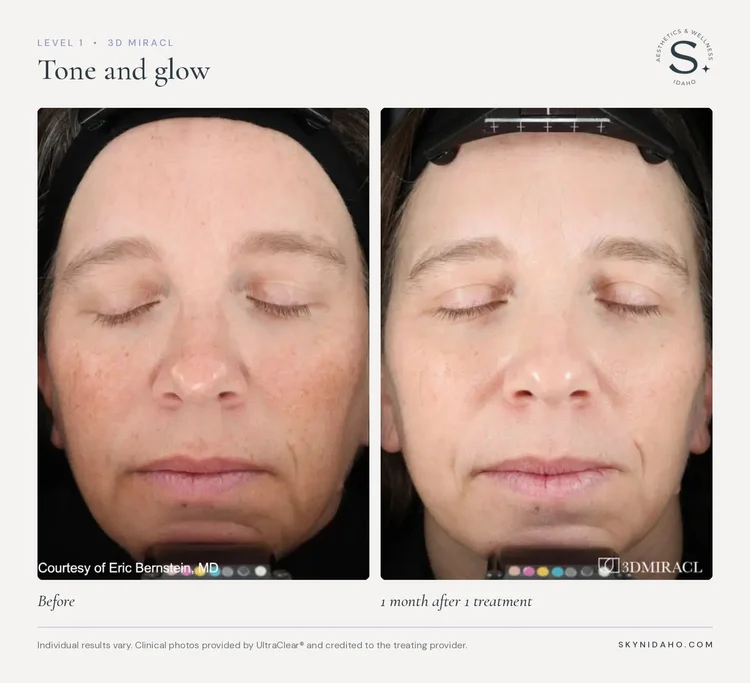 Before and after, Tone and glow, 1 month after 1 treatment, Level 1 · 3D MIRACL