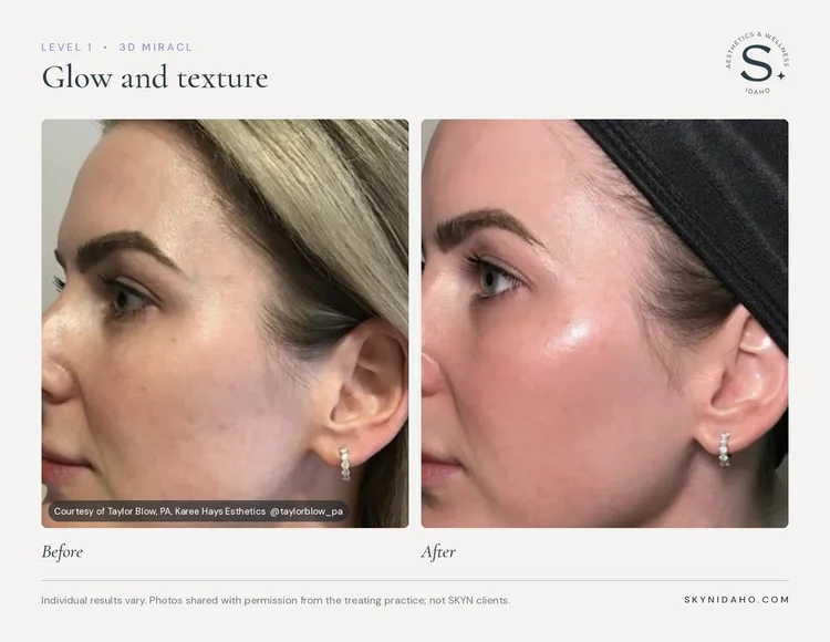 Before and after, Glow and texture, After, Level 1 · 3D MIRACL