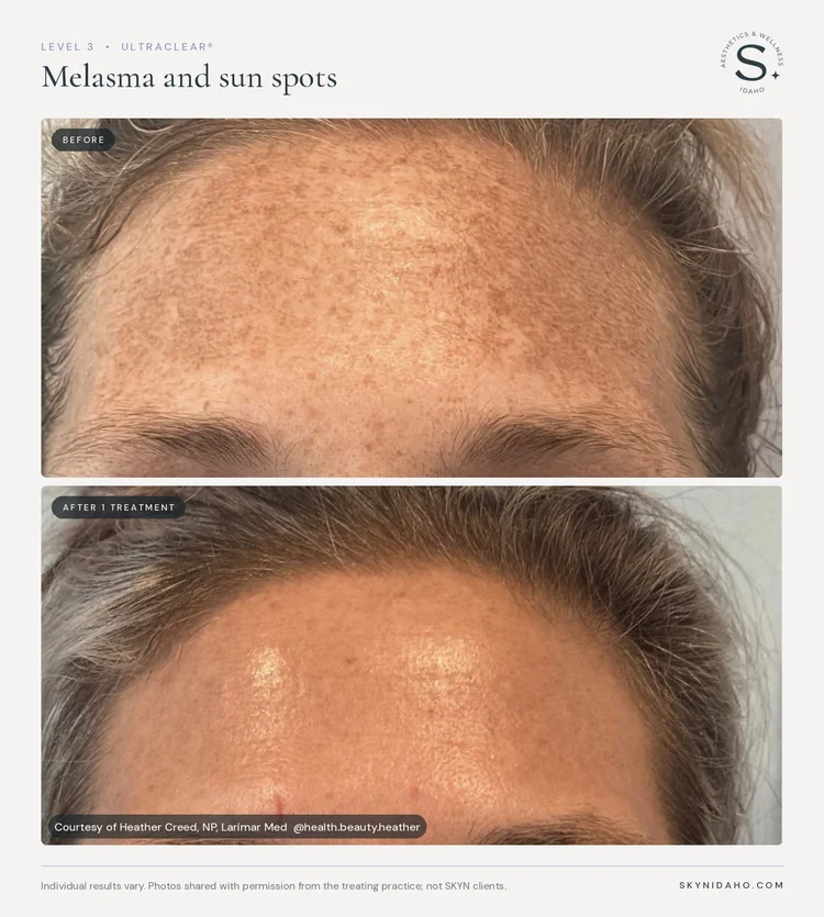 Before and after, Melasma and sun spots, After 1 treatment, Level 3 · UltraClear®
