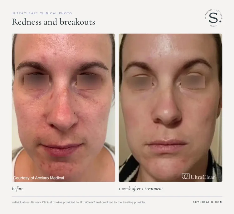 Before and after, Redness and breakouts, 1 week after 1 treatment