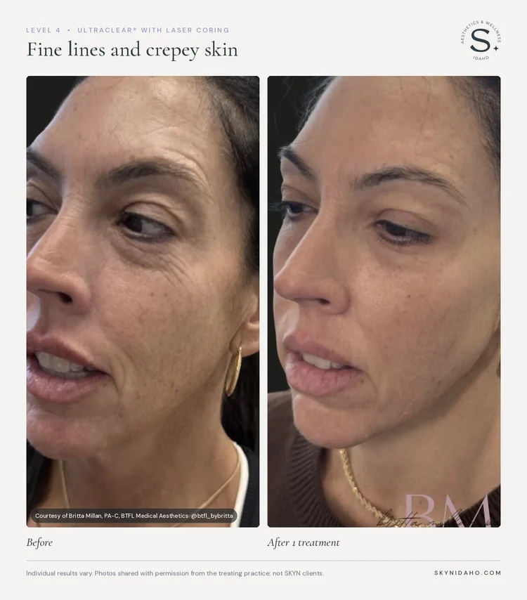 Before and after, Fine lines and crepey skin, After 1 treatment, Level 4 · UltraClear® + Laser Coring