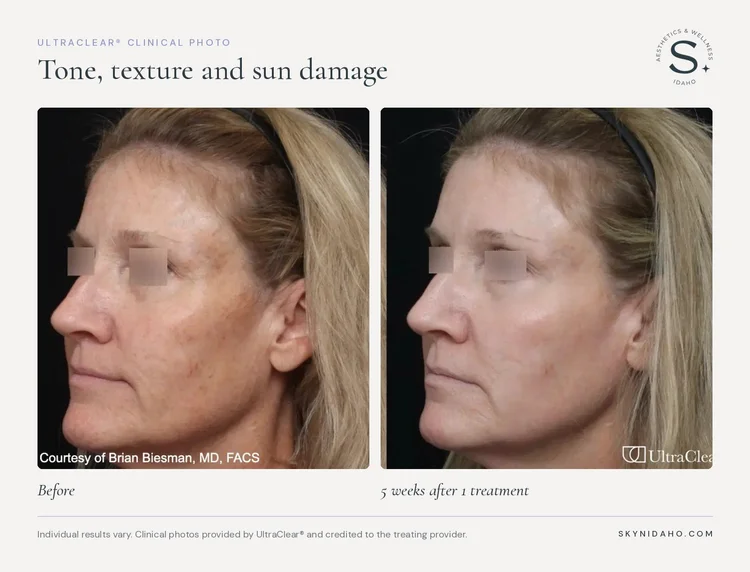 Before and after, Tone, texture and sun damage, 5 weeks after 1 treatment