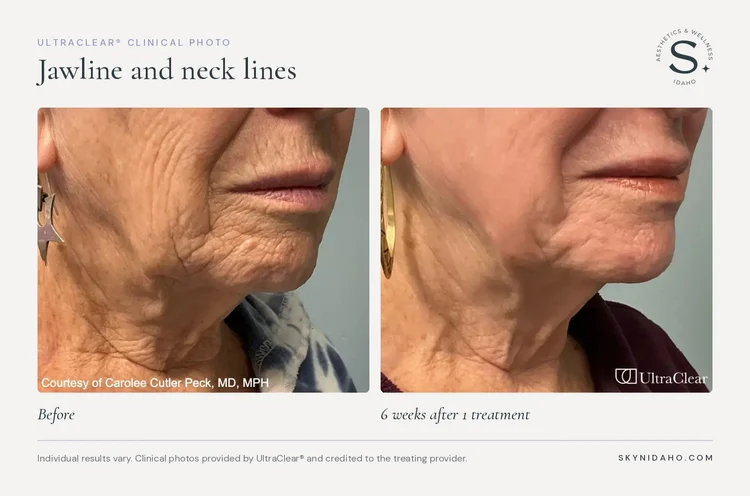 Before and after, Jawline and neck lines, 6 weeks after 1 treatment