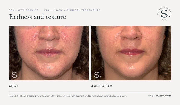 Before and after, Redness and texture, 4 months later