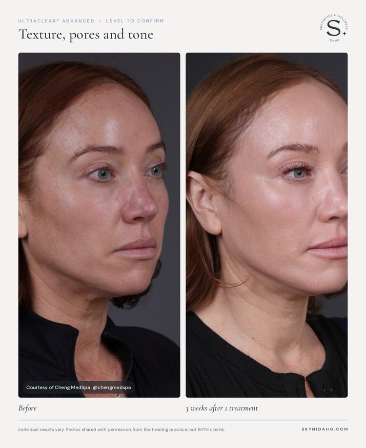 Before and after, Texture, pores and tone, 3 weeks after 1 treatment