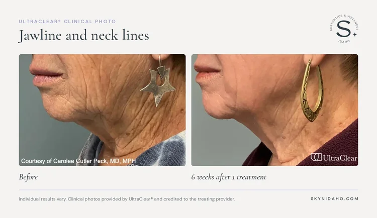 Before and after, Jawline and neck lines, 6 weeks after 1 treatment
