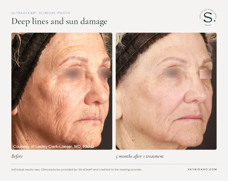 Before and after, Deep lines and sun damage, 5 months after 1 treatment