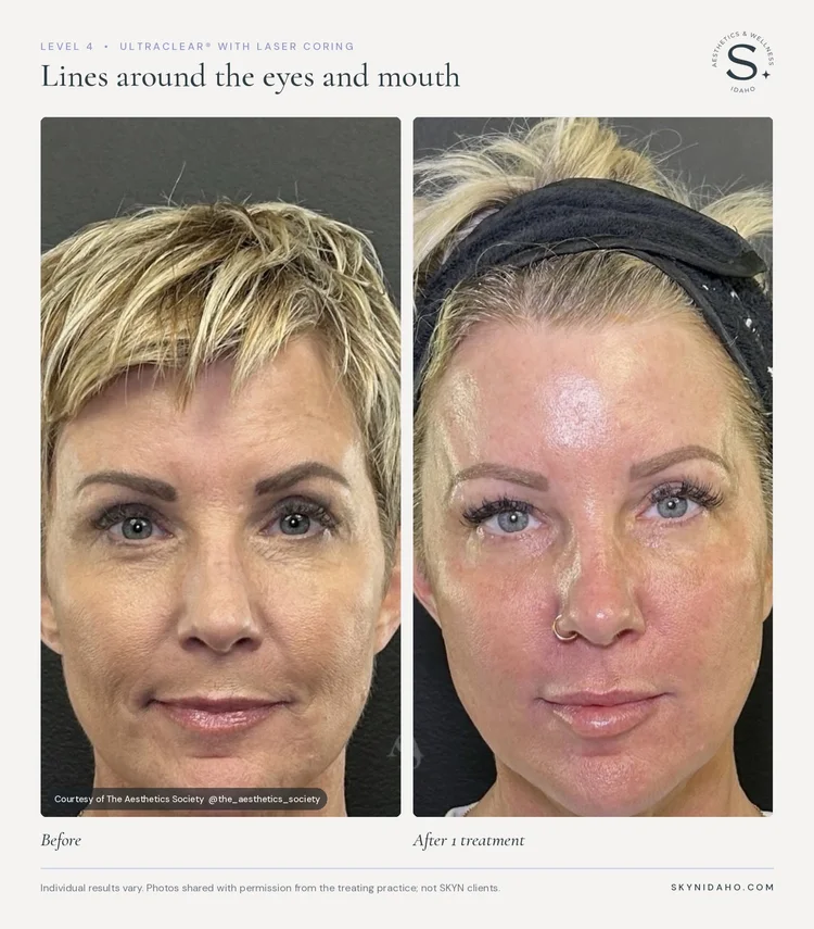 Before and after, Lines around the eyes and mouth, After 1 treatment, Level 4 · UltraClear® + Laser Coring