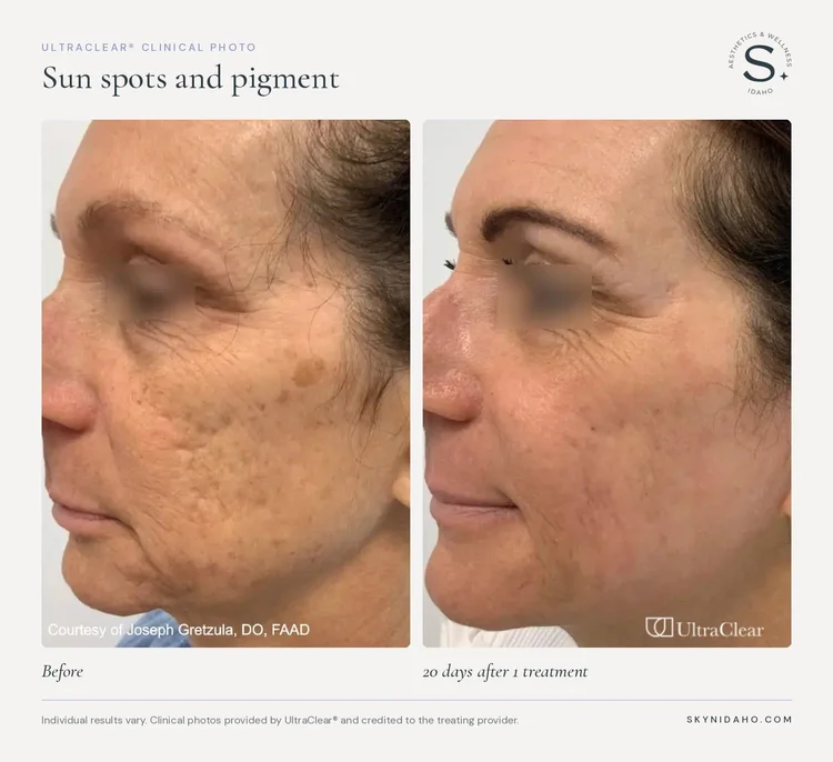 Before and after, Sun spots and pigment, 20 days after 1 treatment