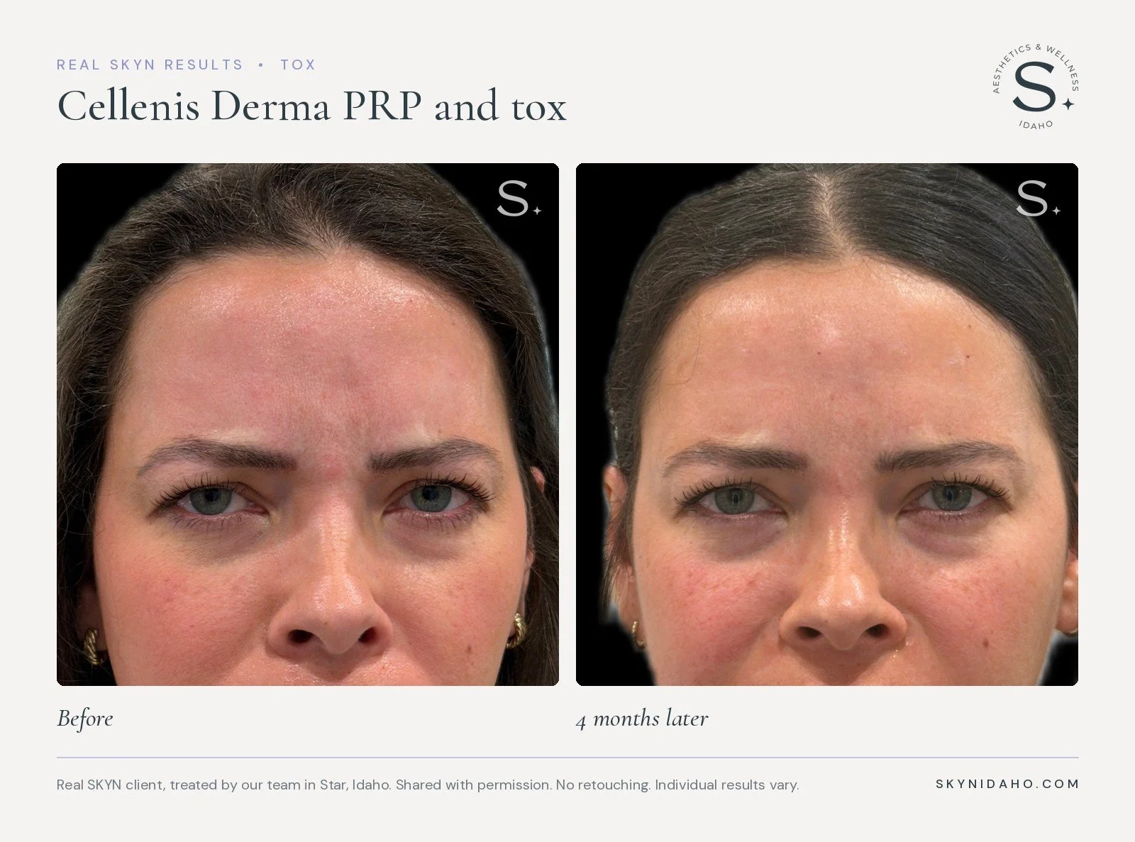 Before and after, PRP and tox, frown lines, 4 months later, at SKYN in Star, Idaho