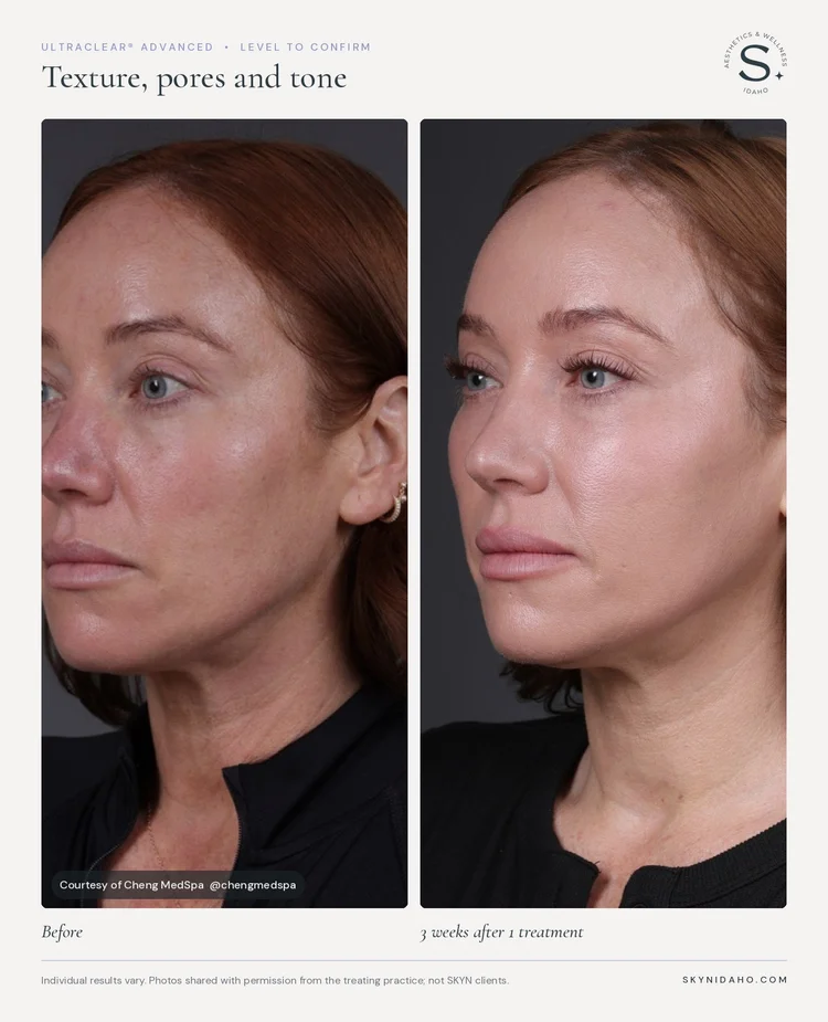 Before and after, Texture, pores and tone, 3 weeks after 1 treatment