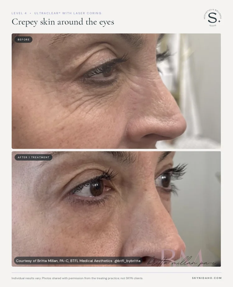 Before and after, Crepey skin around the eyes, After 1 treatment, Level 4 · UltraClear® + Laser Coring