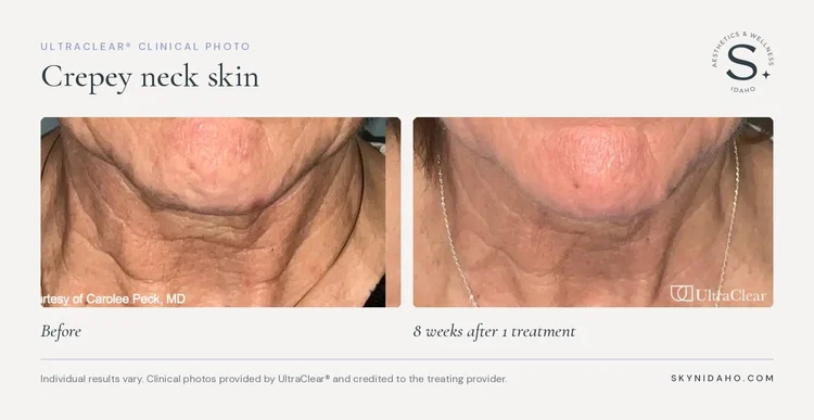 Before and after, Crepey neck skin, 8 weeks after 1 treatment