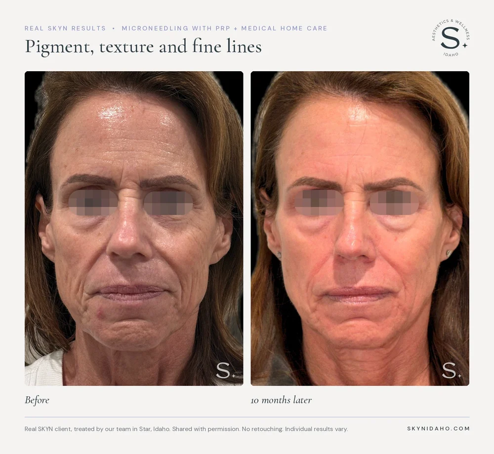 Before and after, Pigment, texture and fine lines, 10 months later