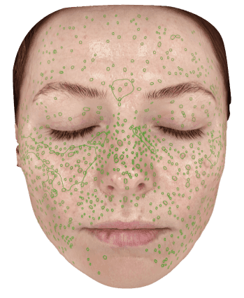 Análisis de manchas pigmentarias de Eve Muse