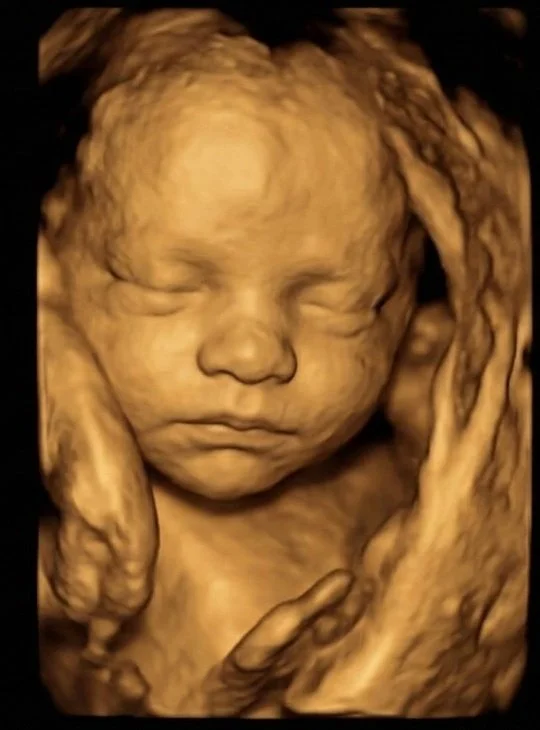 Miracle Clarity 8K AI-enhanced keepsake made from the original ultrasound