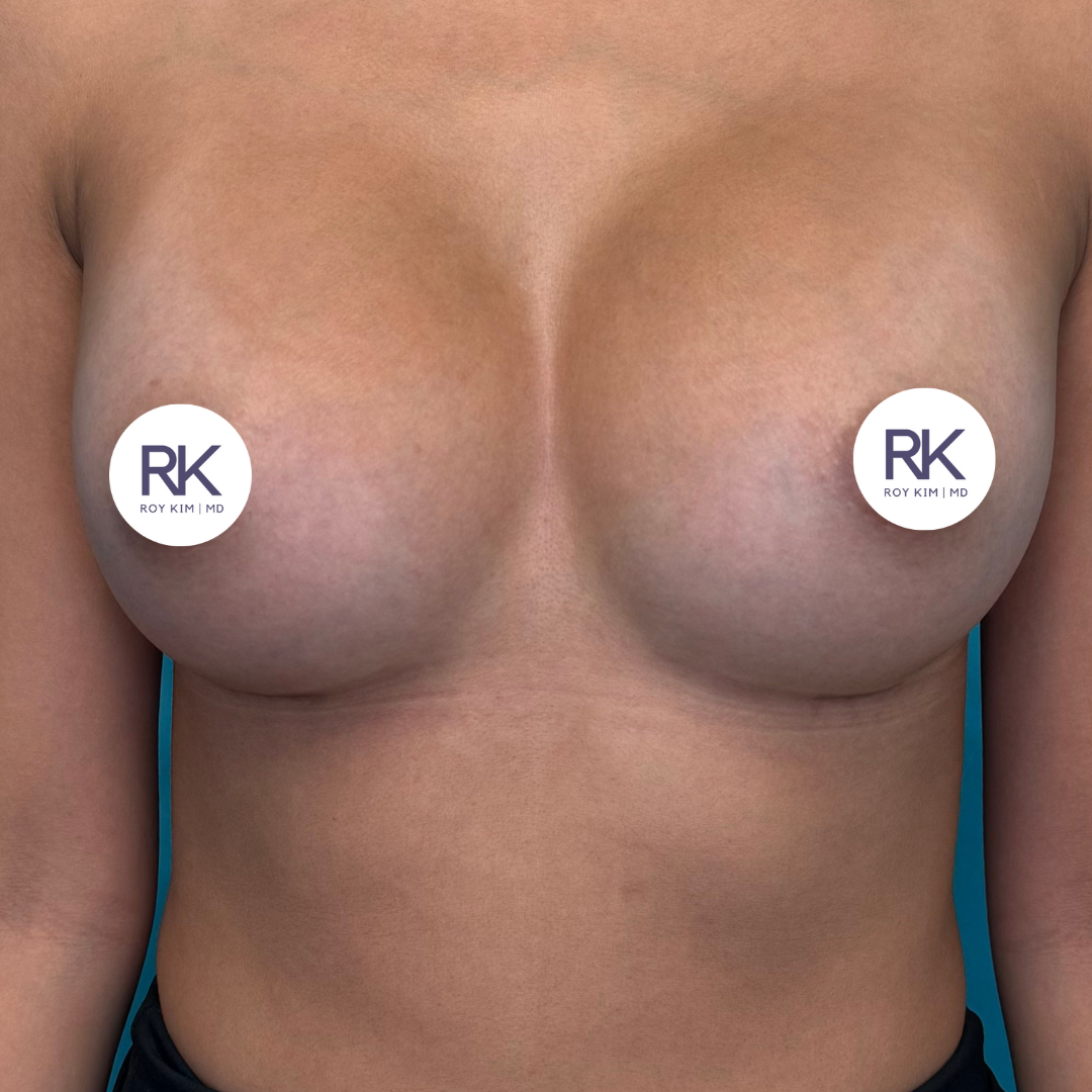 After breast augmentation 350cc