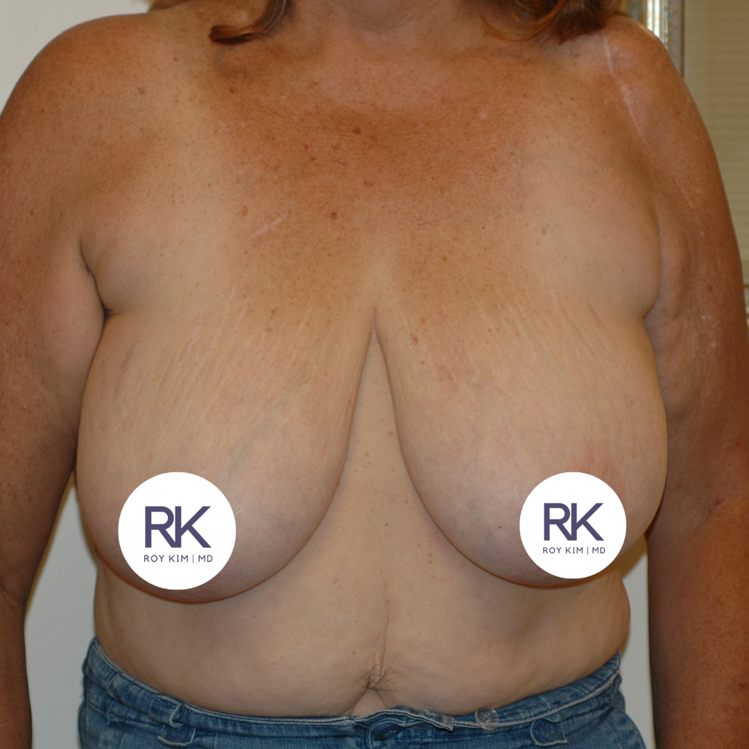 Before breast augmentation 325cc