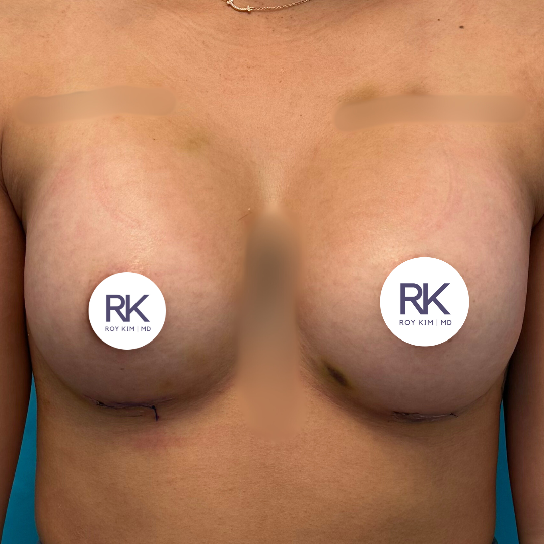 After breast augmentation 300cc