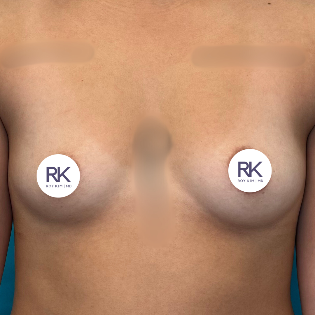 Before breast augmentation 300cc