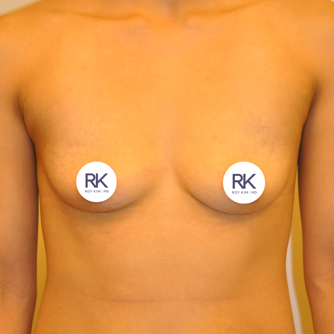 Before breast augmentation 375cc
