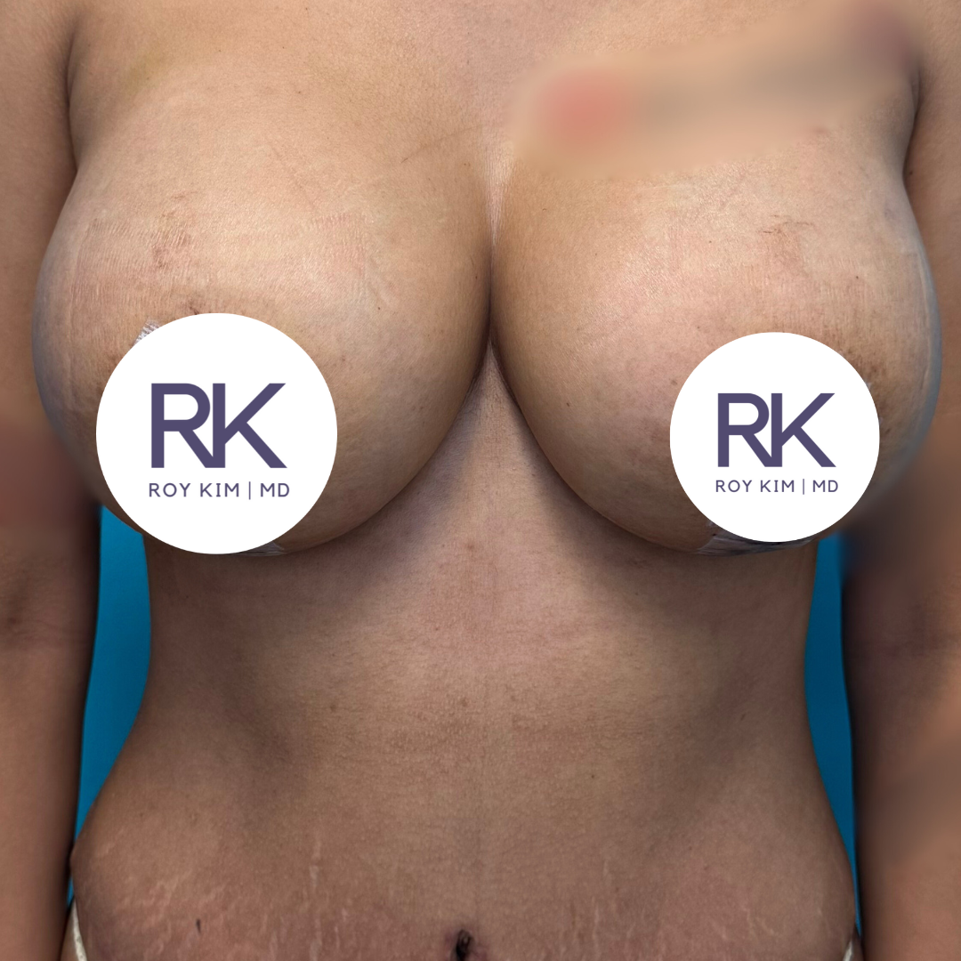 After breast augmentation 325cc