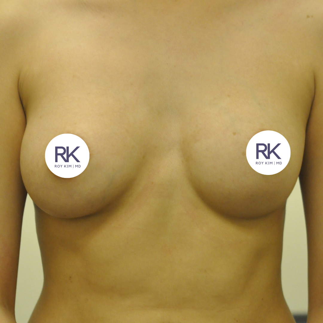 Before breast augmentation 450cc