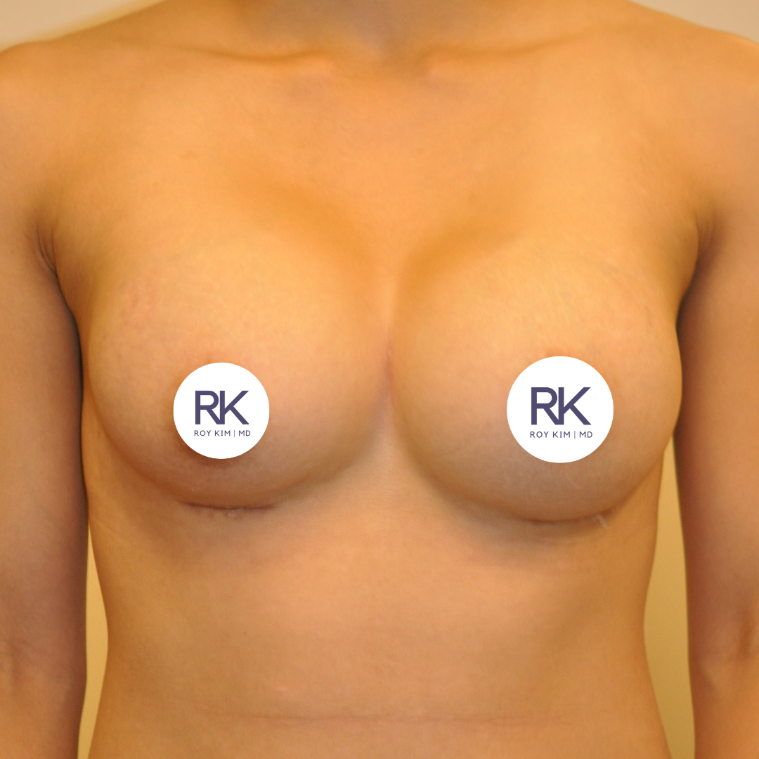 After breast augmentation 375cc