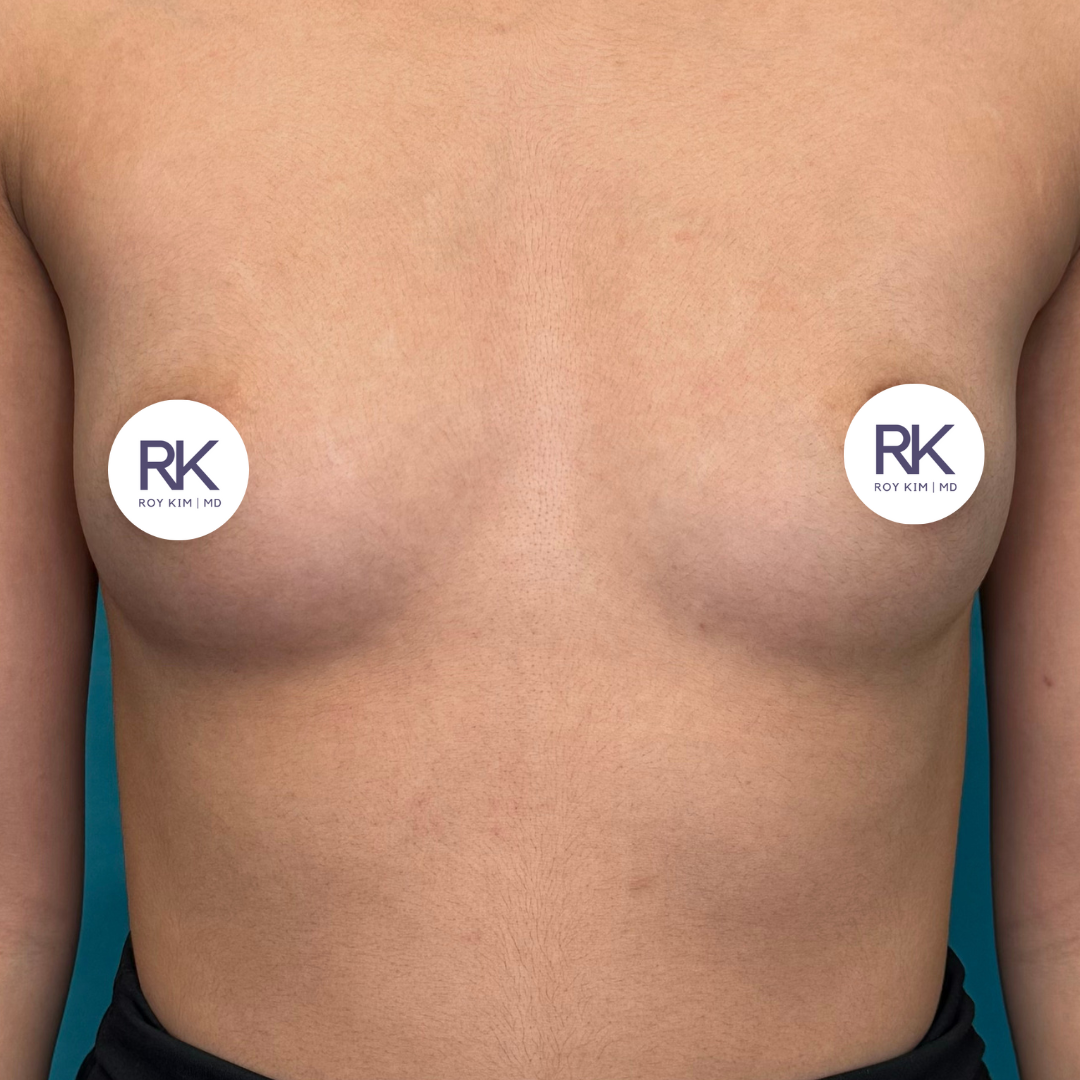 Before breast augmentation 350cc