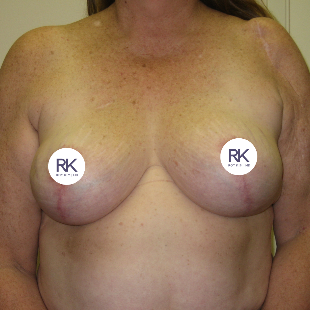 After breast augmentation 325cc